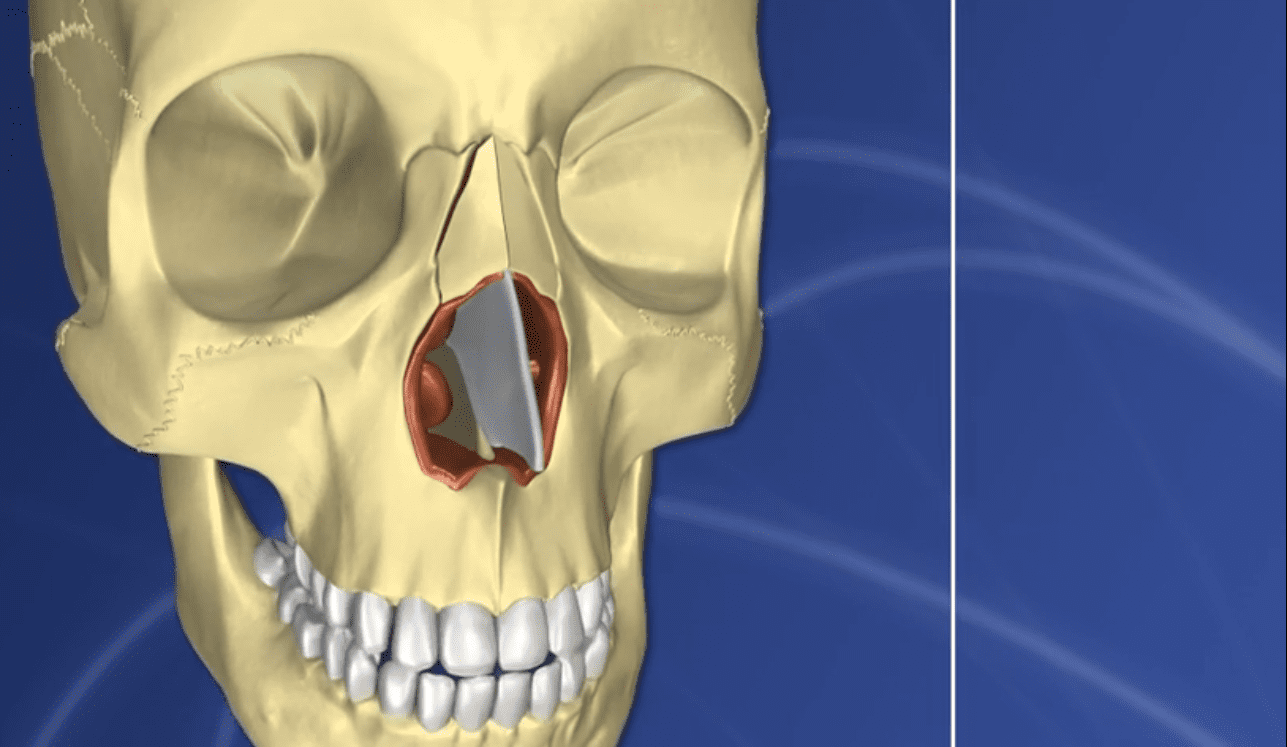Prof. Gottarelli, per gli interventi di rinoplastica o rinosettoplastica